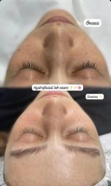 Hydrafacial